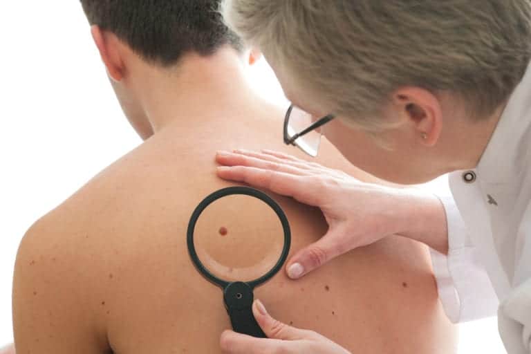 Signs Of Melanoma : What You Should Look For - 3