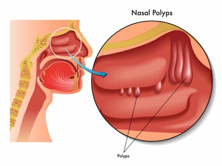 Nasal Polyp Removal And Treatment Options - 8