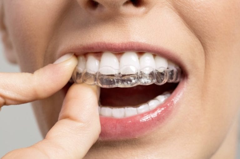 How Much Are Clear (Invisible) Aligners? - 10