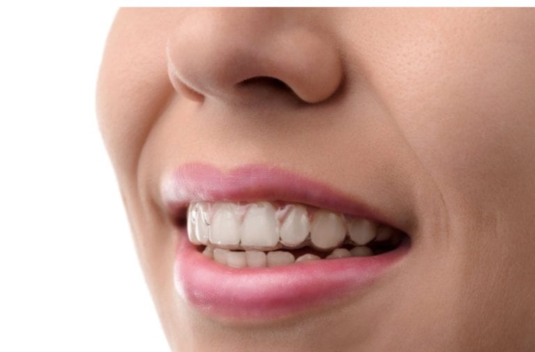 What Is The Best Way To Straighten Teeth Without Braces? - 2