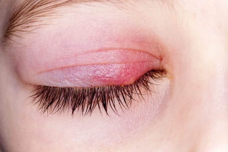 Best Treatments For An Eye Stye - 3