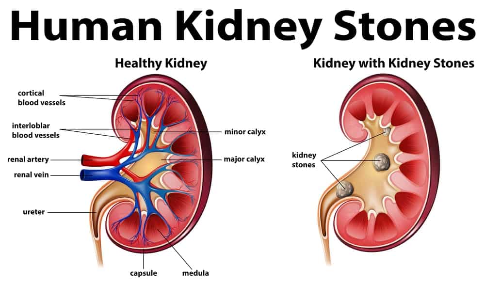Signs And Causes Of Kidney Stones - 1