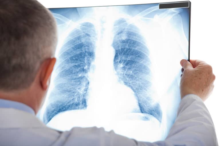 Pulmonary Fibrosis Treatment