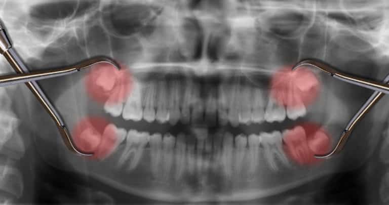 Can Wisdom Teeth Cause Migraines
