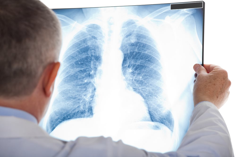 what is proton therapy for lung cancer