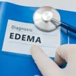 causes of edema