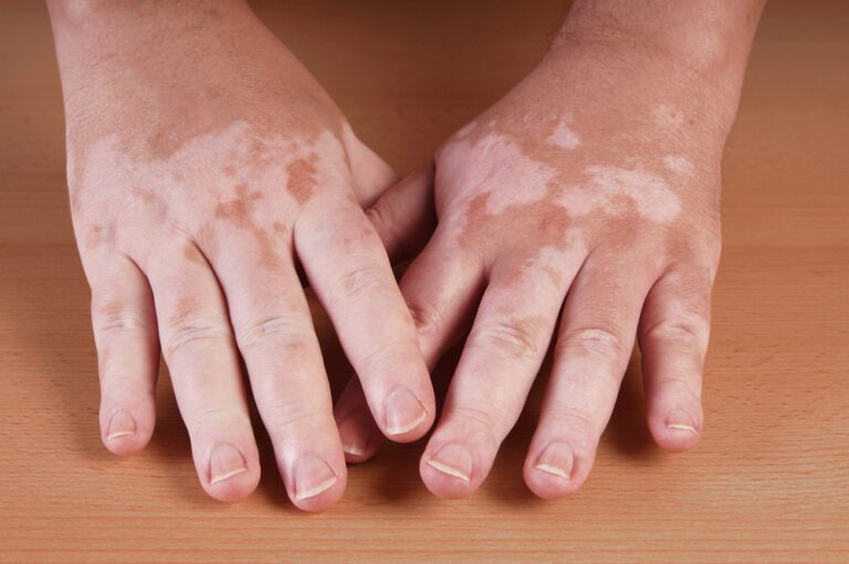 Vitiligo Causes, Symptoms And Treatments - 1
