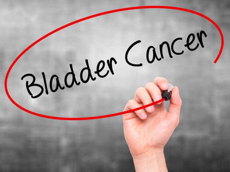 Urothelial Carcinoma: Bladder Cancer Causes, Symptoms, And Treatments - 10